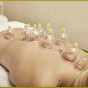 Cupping Therapy
